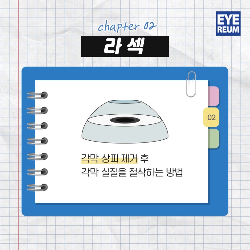 라섹 수술시간, 수술 전 미리 알고가자!