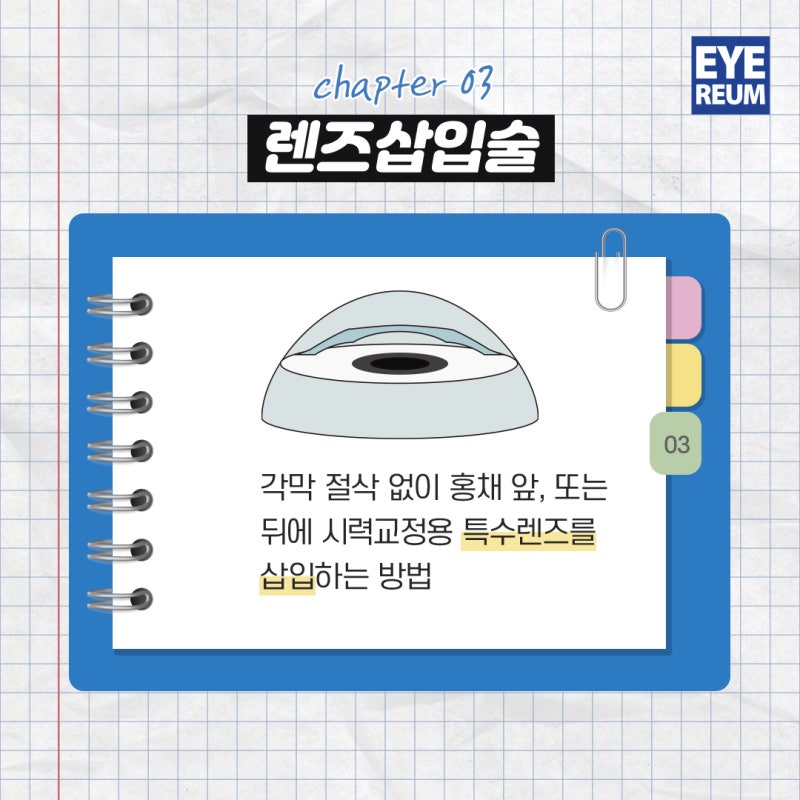 난시교정술 렌즈삽입수술, 왜 아이리움안과일까?