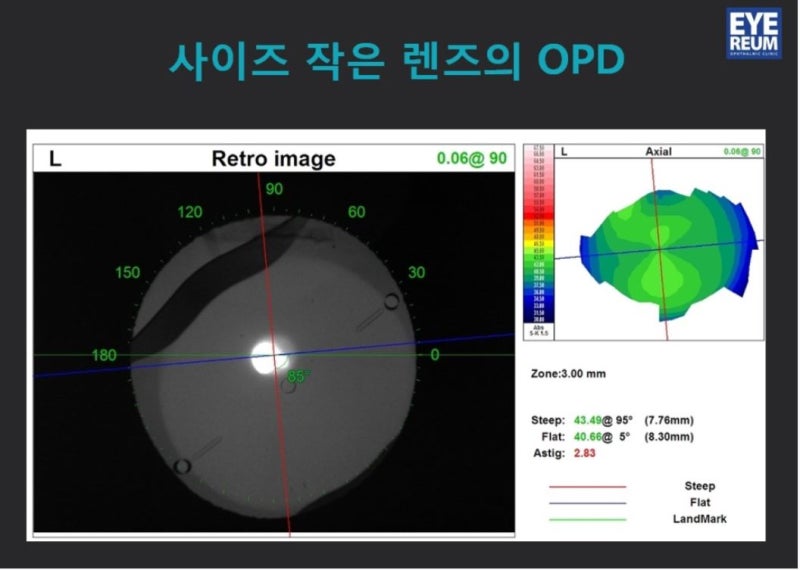ICL렌즈삽입술, 렌즈종류 및 특징 사진 6