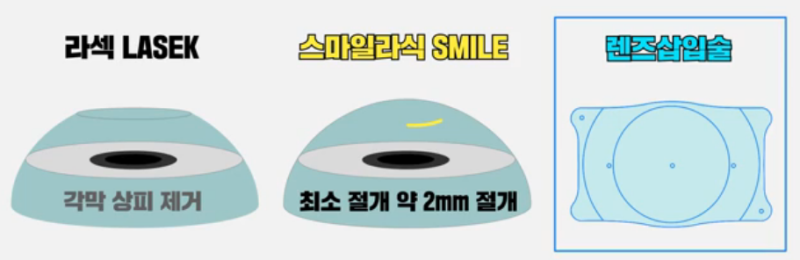 렌즈삽입술 통증 정도와 + 통증 있을 때 대처