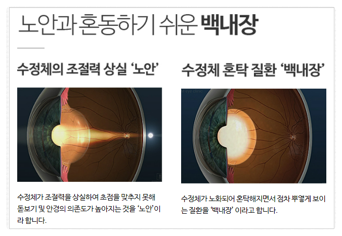 백내장노안수술은 강남역 2번출구 아이리움!