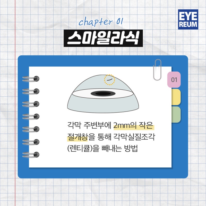 스마일라식 단점, 어떻게 극복할 수 있나
