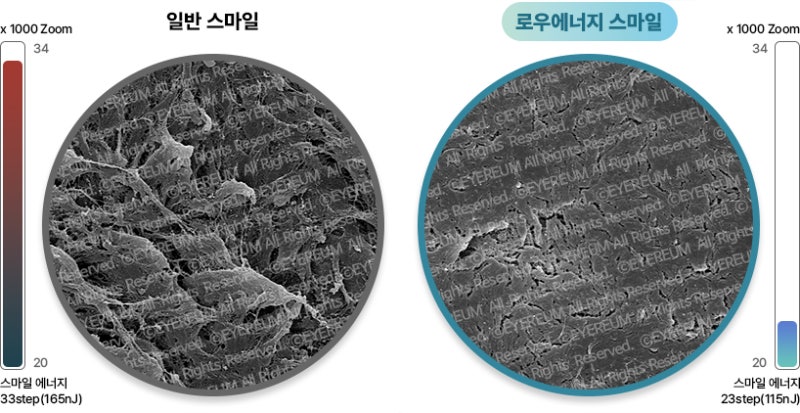 강남역 라식? 로우에너지 스마일라식!