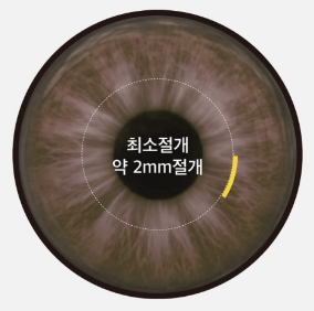 스마일라식, 로우에너지(저에너지)로 수술한다면 뭐가 달라질까?