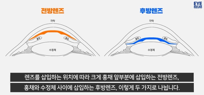 ICL렌즈삽입술 "이 검사" 꼭 해야 하는 이유