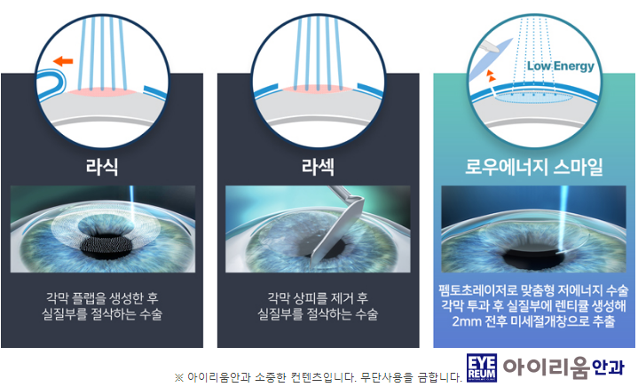강남역 라식 선택기준은?
