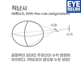 ICL렌즈삽입술 눈 깜빡일 때 렌즈 느껴지나요? - 렌즈삽입술 입문자용 Q&A 사진 3