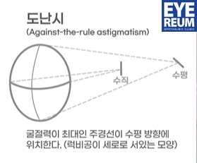 ICL렌즈삽입술 눈 깜빡일 때 렌즈 느껴지나요? - 렌즈삽입술 입문자용 Q&A 사진 4