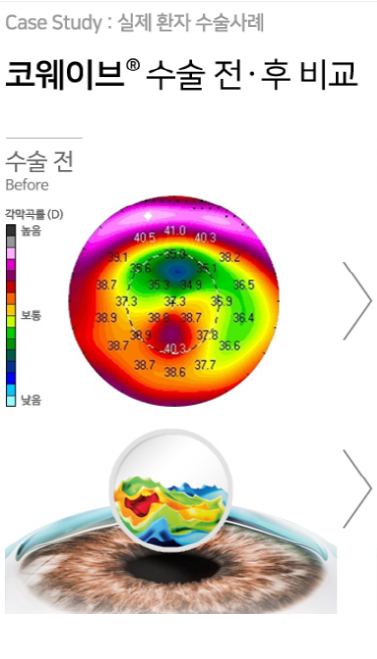 스마일라식 라섹 차이, 이렇게 비교했어요 사진 17