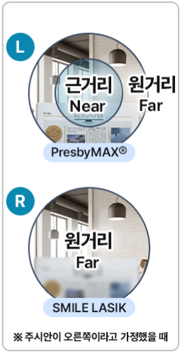 노안수술 후기 노안교정수술가격 요약본(24년 9월 기준) 사진 11