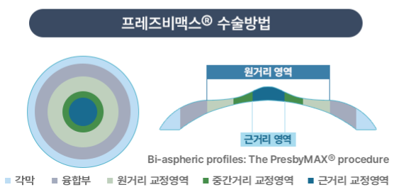 50대 노안수술 고려한다면 필독 사진 6