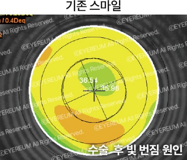 강남 라식 안과 로우에너지 스마일 사진 5