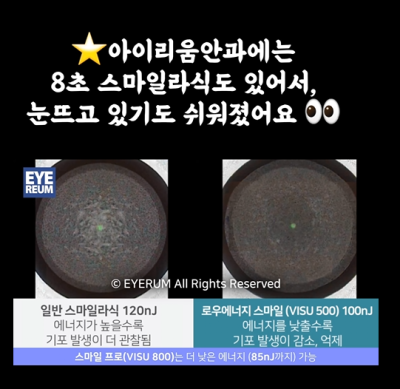 강남 라식 안과 로우에너지 스마일 사진 18