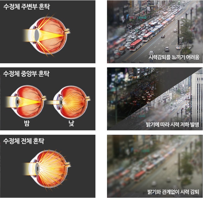 백내장수술가격 알아보고 있다면, 좋은 수술결과를 위한 안과 조언