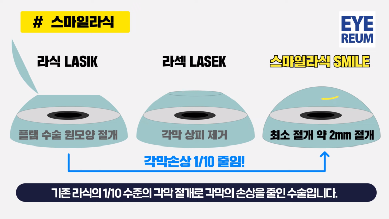 스마일라식 프로 가격이벤트(+라섹)_11월기준