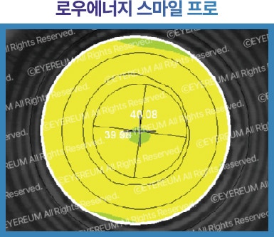 스마일프로병원 어디로 가야할까? 안과선택tip 사진 14