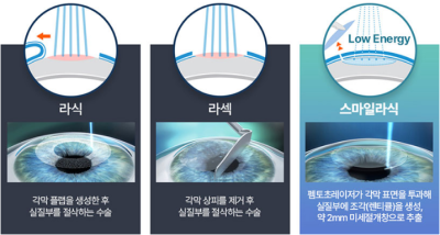 스마일라식의 진화, 빛번짐 해결을 위한 수술법 사진 3