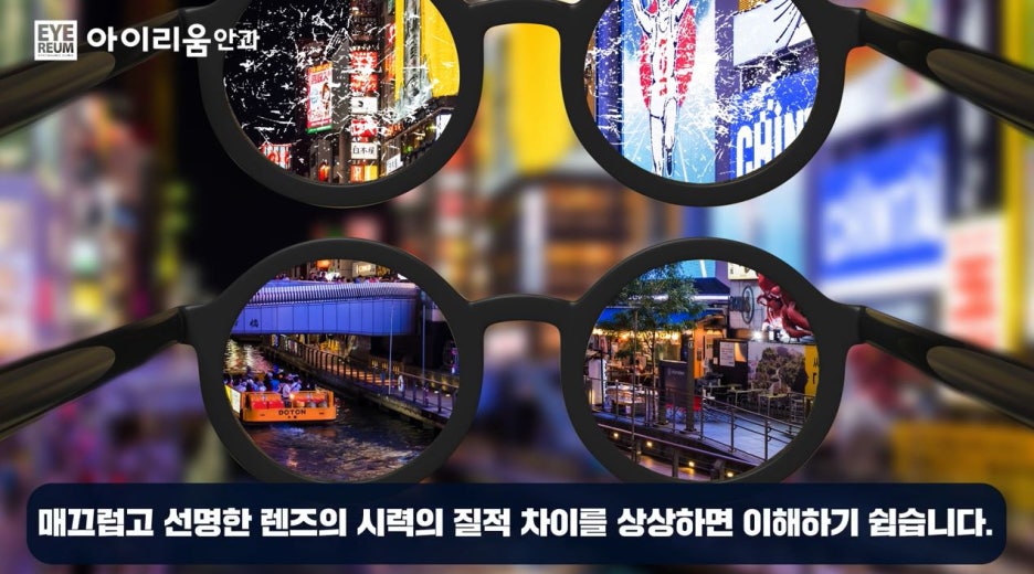 스마일라식의 진화, 빛번짐 해결을 위한 수술법 사진 12