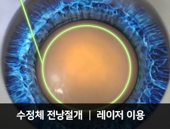 40-50대 시력불편, 노안교정 방법(노안라식, 노안렌즈삽입술 등) 사진 21