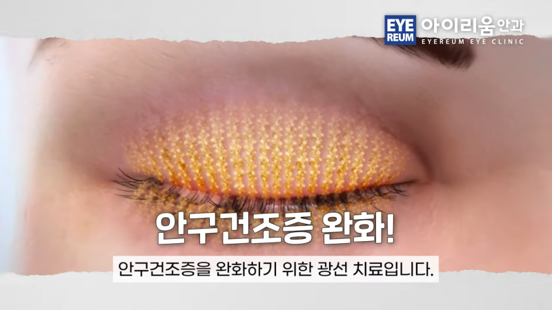 안구건조증 치료, 에어컨 바람 때문에 눈이 더 건조하다면? 사진 10