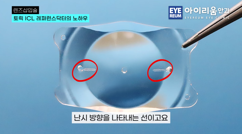 ICL 잘하는 안과 고르는 방법② -렌즈 사이즈·볼팅·토릭ICL이 중요한 이유 사진 6