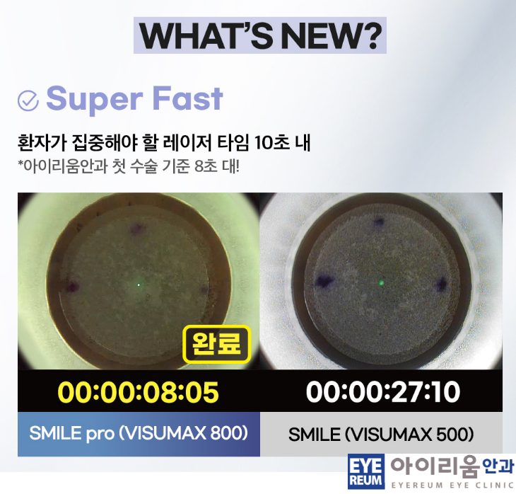 스마일라식, 스마일프로, 스마트노바 차이점은? 레이저 장비부터 수술법, 가격까지 비교 사진 4