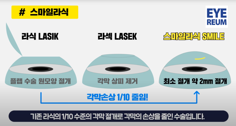 스마일라식, 스마일프로, 스마트노바 차이점은? 레이저 장비부터 수술법, 가격까지 비교 사진 3
