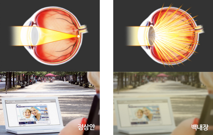 백내장수술, 언제 해야 할까요? 시력보다 중요한 '수술 시기'와 정밀검사 사진 2