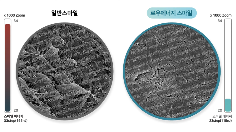 스마일라식, 같은 1.0 시력인데 만족도는 왜 다를까? 고위수차와 '시력의 질'이 중요한 이유 사진 5