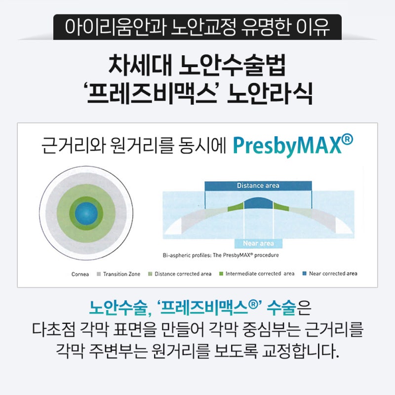 40대 스마일라식, 노안교정까지 가능할까요? -강성용원장 싱가포르 국제학회(SNEC) 발표 핵심정리 사진 5