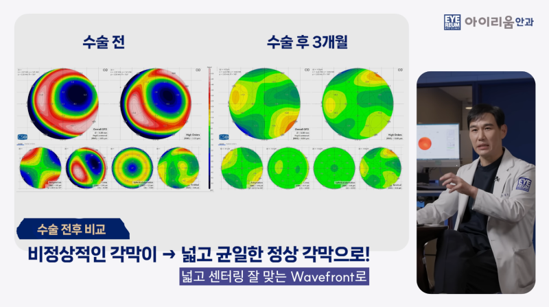 20년 전 라식했다면? 라식 1세대의 백내장수술은 달라야 합니다. 사진 8