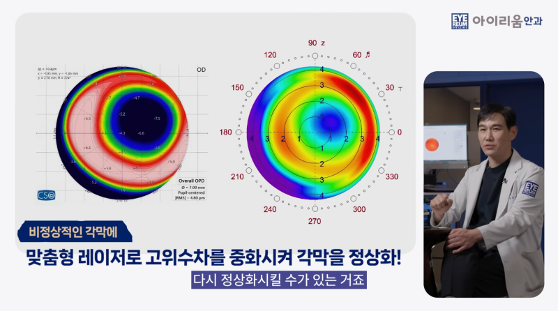 20년 전 라식했다면? 라식 1세대의 백내장수술은 달라야 합니다. 사진 7