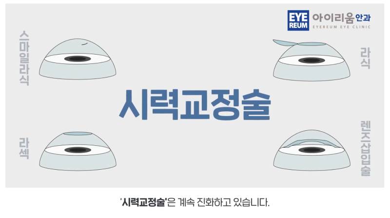 강남안과 어디로 갈까? 스마일라식·렌즈삽입술 알아보기 전 check 사진 2