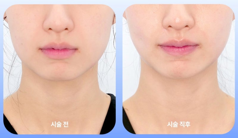 강남역 덴서티 첫 시술 전 꼭 알아야 할 3가지 – 효과·유지기간·통증까지