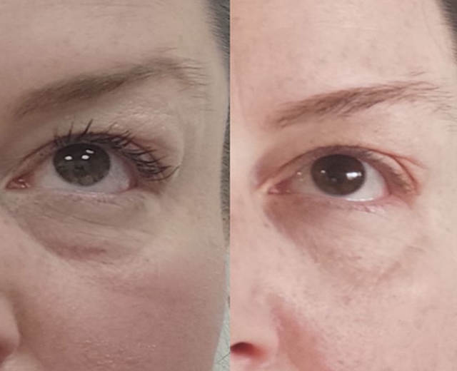 눈가 잔주름, 근육부터 보는 이유 — 루메니스 EyeLift Symposium 발표 정리 사진 20