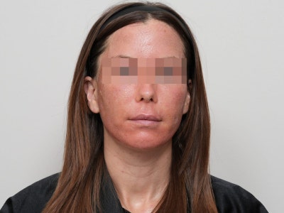 여드름 흉터 프락셀, 몇 번에 얼마나 좋아질까? 유형별 치료 단계 총정리 사진 9