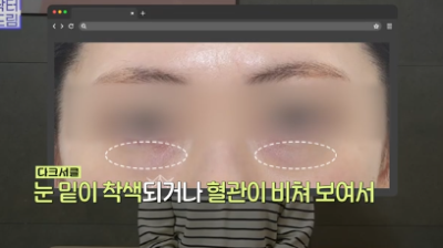 Phẫu thuật trung niên mà cả Jun Hyun-moo cũng làm, đây chính là sự thật