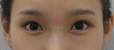 광대뼈와 뒤트임수술의 시너지효과