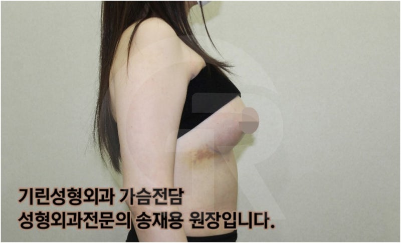 가슴확대수술 후 관리방법, 실제사례 알아보다. [기린성형외과의원_Dr.송재용] 사진 7