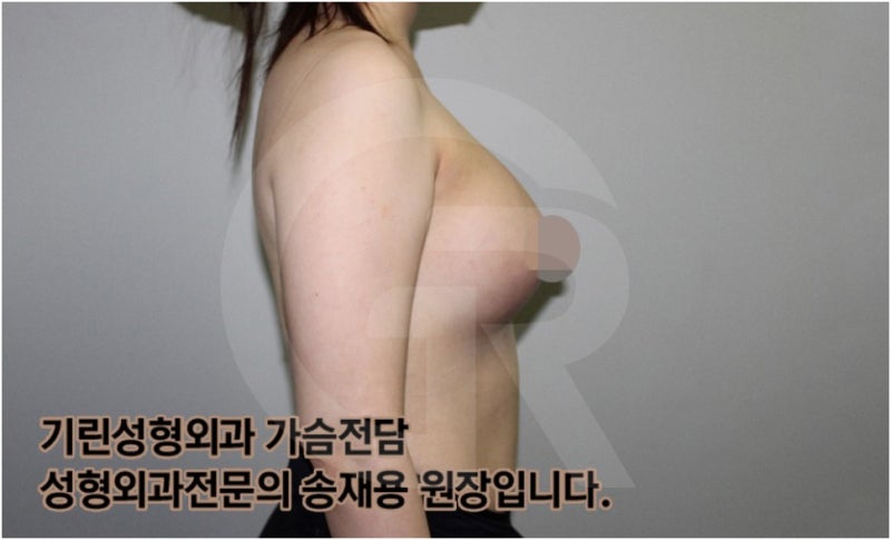 가슴확대수술 후 관리방법, 실제사례 알아보다. [기린성형외과의원_Dr.송재용] 사진 17