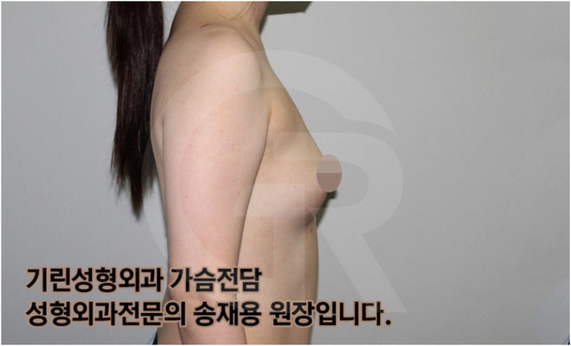 가슴확대수술 후 관리방법, 실제사례 알아보다. [기린성형외과의원_Dr.송재용] 사진 16