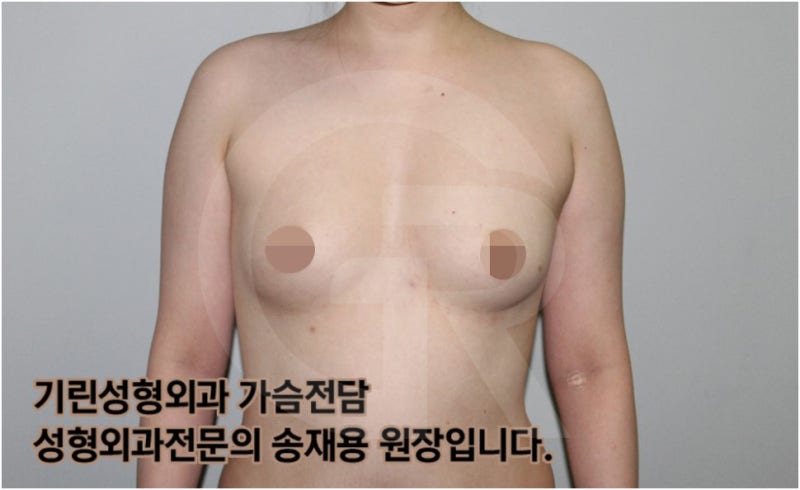 가슴확대수술 후 관리방법, 실제사례 알아보다. [기린성형외과의원_Dr.송재용]