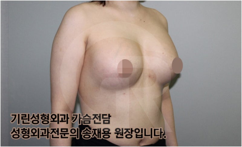 가슴확대수술 후 관리방법, 실제사례 알아보다. [기린성형외과의원_Dr.송재용] 사진 12