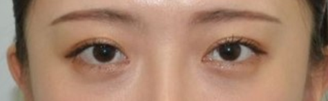 뒤트임 눈성형수술, 기린만의 특별화된 7mm 뒤트임. 사진 3