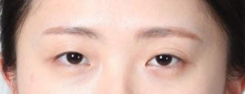 뒤트임 눈성형수술, 기린만의 특별화된 7mm 뒤트임. 사진 2