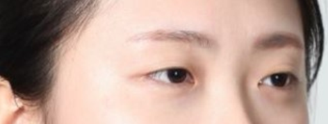 뒤트임 눈성형수술, 기린만의 특별화된 7mm 뒤트임. 사진 4