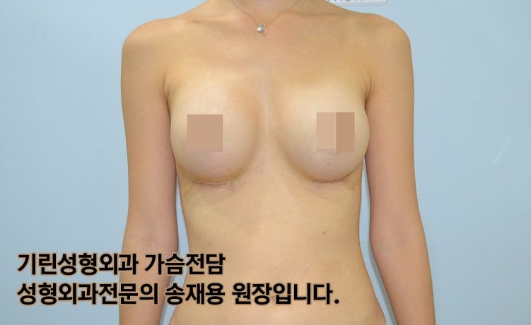 [가슴성형절개방식]밑선절개 흉터와 회복기간 (+실제사례)
