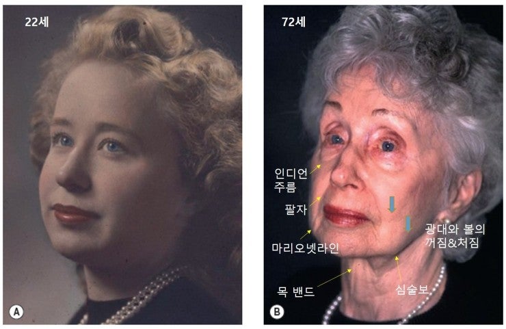 [공유] 안면거상술 고민중이시라면 꼭 읽어보세요! 안면거상술 어떤 분들에게 필요하고, 어떤 효과가 있는 수술인가?