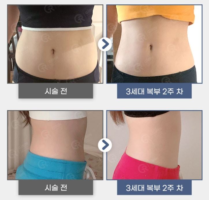 복부지방분해주사? 나에게도 잘 맞을까?