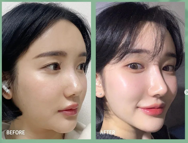 낮은코수술 눈에 보이는 차이를 원한다면 사진 12
